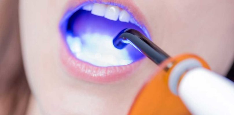 «Голливудская» улыбка: какие процедуры проводятся после лечения у ортодонта
